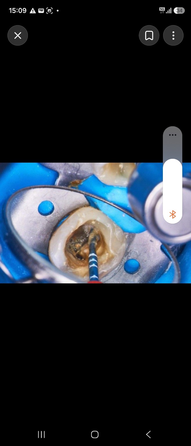 Detail ošetření kořenového kanálku nástrojem v modrém kofferdamu.