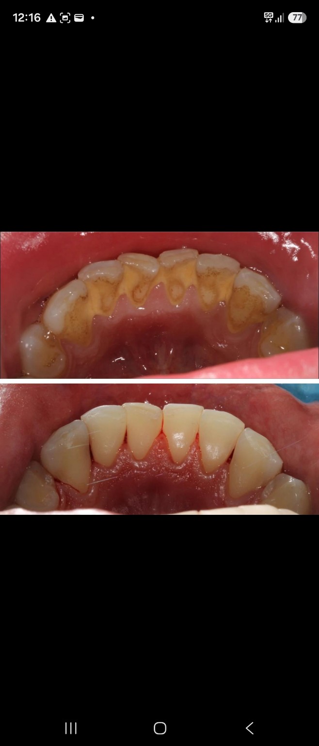 Zuby před dentální hygienou s výrazným zubním kamenem a po jeho odstranění.