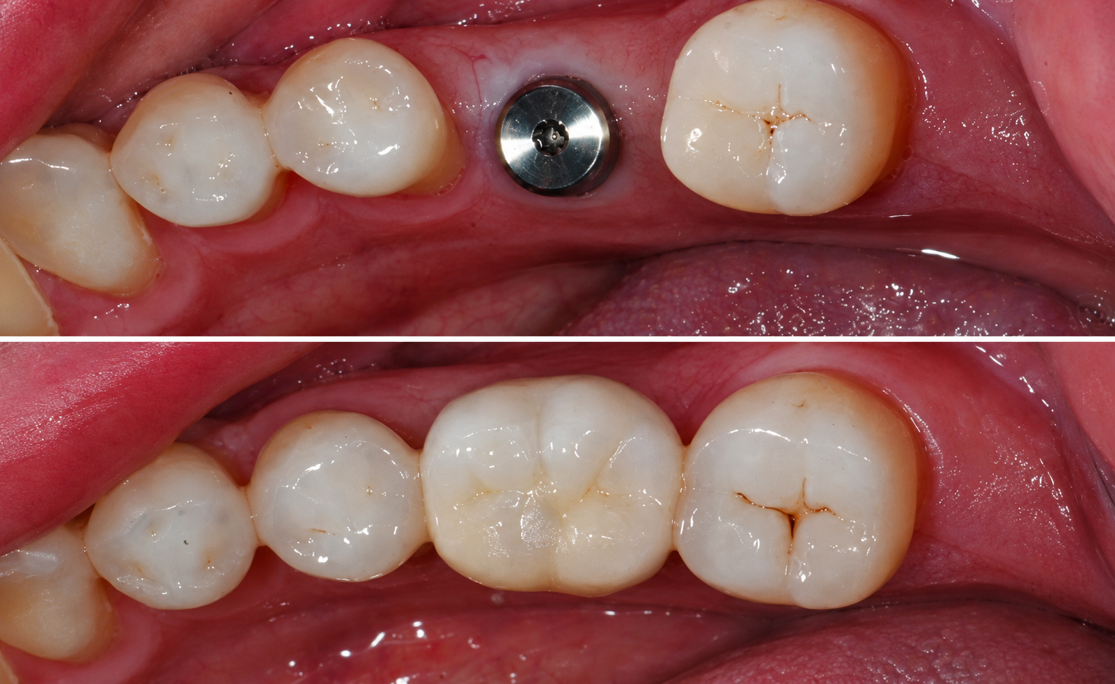 Ukázka implantátu v oblasti stoličky před nasazením korunky a s nasazenou korunkou.